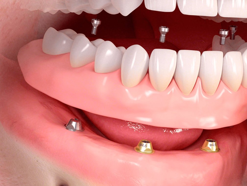 Неправильное протезирование зубов